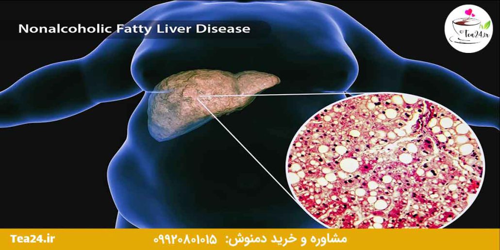 این تصویر کبد چرب را نشان میدهد