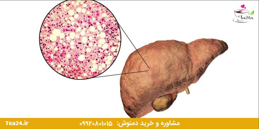 این تصویر علایم کبد چرب را نشان میدهد