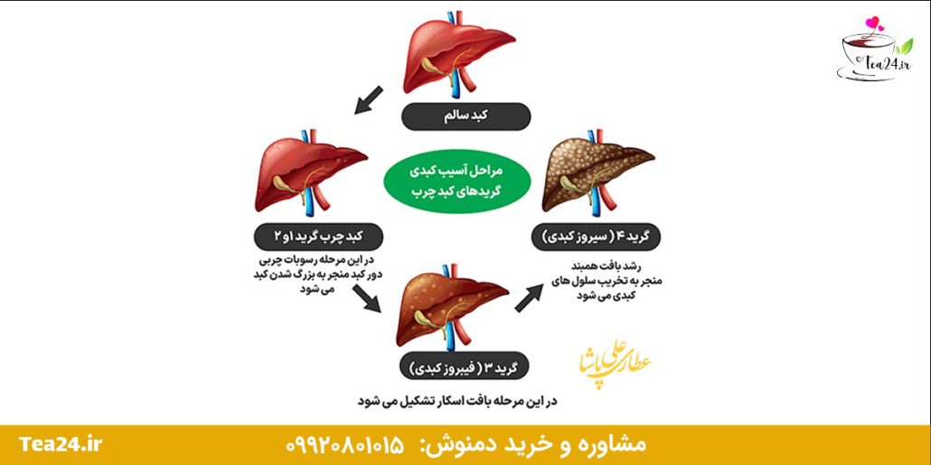 این تصویر مراحل نارسایی کبد را نشان می دهد