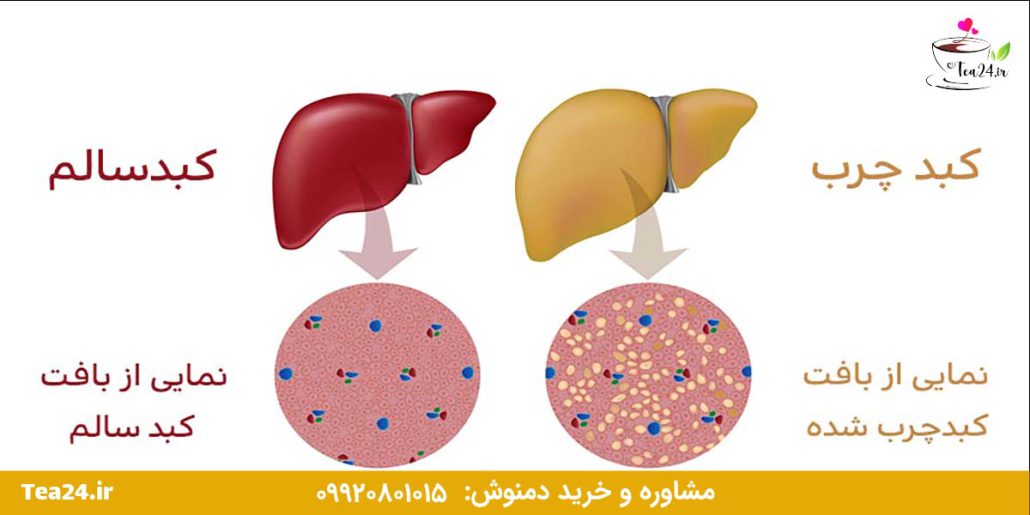 این تصویر کبد چرب و کبد سالم است